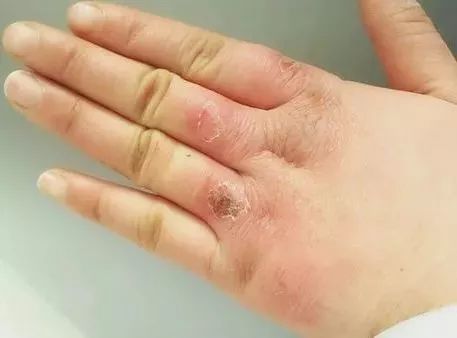 天寒地冻，当心冻伤！治疗冻疮的6个秘方……